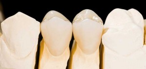 crowns at eagle dental practice Liphook