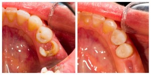 natural fillings at eagle dental practice Liphook